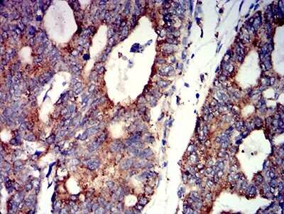 Immunohistochemistry-Paraffin: Nicotinic Acetylcholine R alpha 7/CHRNA7 Antibody (7F10G1) [NBP2-61739] - Analysis of rectum cancer tissues using CHRNA7 mouse mAb with DAB staining.