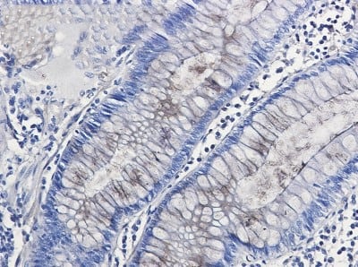 Immunohistochemistry-Paraffin: Nidogen-1/Entactin Antibody (S08-3H3) [NBP3-19860] - Immunohistochemistry of Nidogen-1/Entactin in paraffin-embedded Human colon cancer tissue using NBP3-19860 at dilution 1/50