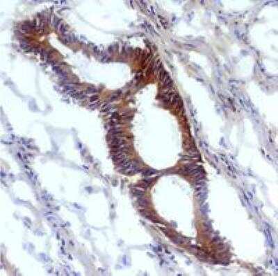 Immunohistochemistry-Frozen: Nitrotyrosine Antibody (EM-30) [NBP1-96130] - Human tumoral colon epithelium with anti-nitrotyrosine antibody (EM-30).