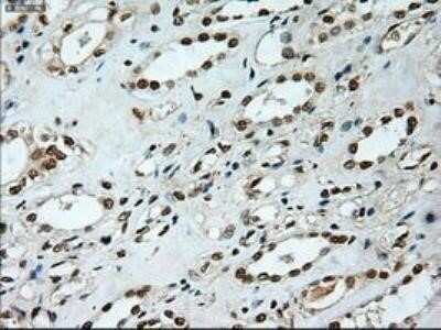 Immunohistochemistry: Notch-1 Antibody (OTI3E12) - Azide and BSA Free [NBP2-73042] - Staining of paraffin-embedded Carcinoma of lung using anti-Notch1 mouse monoclonal antibody.