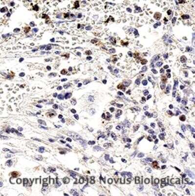 Immunohistochemistry: Notch-1 Antibody (mN1A) - Azide and BSA Free [NBP2-80884] - Analysis of FFPE human pancreatic cancer using 1:10 dilution of Notch-1 antibody on a Bond Rx autostainer (Leica Biosystems). The assay involved 20 minutes of heat induced antigen retrieval (HIER) using 10mM sodium citrate buffer (pH 6.0) and endogenous p