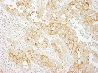 <b>Independent Antibodies Validation and Biological Strategies Validation.</b>Immunohistochemistry-Paraffin: Notch-2 Antibody [NBP1-19125] - Sample: FFPE section of human breast carcinoma. Antibody: Affinity purified rabbit anti- Notch2 used at a dilution of 1:200 (1ug/ml). Detection: DAB