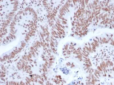 Immunohistochemistry-Paraffin: Nrf1 Antibody (NRF1/2608) [NBP3-08751] - Formalin-fixed, paraffin-embedded human Colon Carcinoma stained with Nrf1 Mouse Monoclonal Antibody (Nrf1/2608).