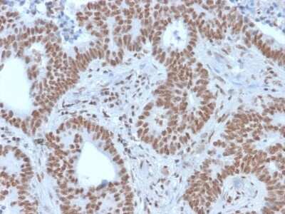 Immunohistochemistry-Paraffin: Nrf1 Antibody (NRF1/2609) - Azide and BSA Free [NBP3-08773] - Formalin-fixed, paraffin-embedded human colon carcinoma stained with Nrf1 Mouse Monoclonal Antibody (Nrf1/2609).