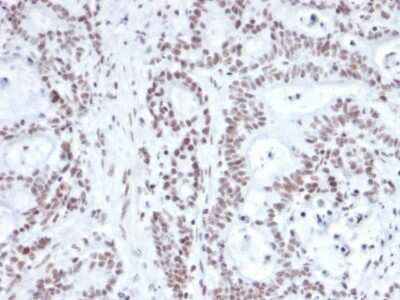 Immunohistochemistry-Paraffin: Nrf1 Antibody (NRF1/2609) - Azide and BSA Free [NBP3-08773] - Formalin-fixed, paraffin-embedded human prostate carcinoma stained with Nrf1 Mouse Monoclonal Antibody (Nrf1/2609).