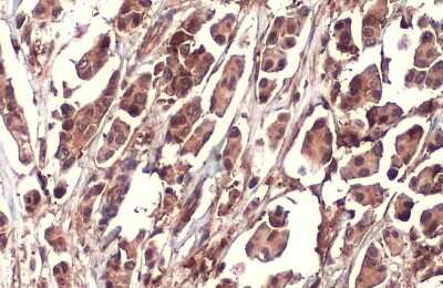 Immunohistochemistry-Paraffin: Nrf2 Antibody (HL1021) [NBP3-13682] - Human breast carcinoma. Nrf2 stained by Nrf2 antibody [HL1021] (NBP3-13682) diluted at 1:100. Antigen Retrieval: Citrate buffer, pH 6.0, 15 min