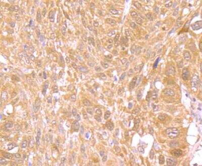 Immunohistochemistry-Paraffin: Nrf2 Antibody [NBP3-09069] - Immunohistochemical analysis of paraffin-embedded human lung tissue using anti-Nrf2 antibody. The section was pre-treated using heat mediated antigen retrieval with Tris-EDTA buffer (pH 8.0-8.4) for 20 minutes.The tissues were blocked in 5% BSA for 30 minutes at room temperature, washed with ddH2O and PBS, and then probed with the primary antibody (1/100) for 30 minutes at room temperature. The detection was performed using an HRP conjugated compact polymer system. DAB was used as the chromogen. Tissues were counterstained with hematoxylin and mounted with DPX.