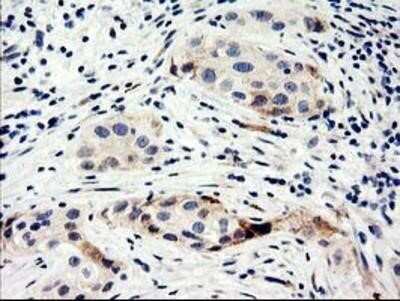Immunohistochemistry: Nucleobindin 1 Antibody (OTI1A5) - Azide and BSA Free [NBP2-73086] - Staining of paraffin-embedded Carcinoma of Human bladder tissue using anti-Nucleobindin 1 mouse monoclonal antibody.