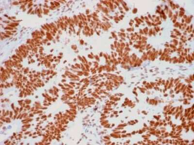 Immunohistochemistry-Paraffin: Nucleoli Marker Antibody (NM95) - Azide and BSA Free [NBP2-34695] - Formalin-fixed, paraffin-embedded human Colon Carcinoma stained with Nucleoli Marker Antibody (NM95).