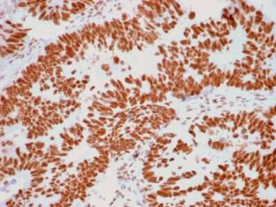 Immunohistochemistry-Paraffin: Nucleoli Marker Antibody (NM95) [NBP2-32886] - Formalin-fixed, paraffin-embedded human Colon Carcinoma stained with Nucleoli Marker Antibody (NM95).
