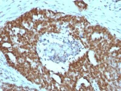 Immunohistochemistry-Paraffin: Nucleolin Antibody (NCL/902) - Azide and BSA Free [NBP2-47860] - Human Ovarian Carcinoma stained with Nucleolin Monoclonal Antibody (NCL/902).