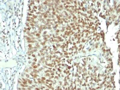 Immunohistochemistry-Paraffin: Nucleolin Antibody (NCL/902) - Azide and BSA Free [NBP2-47860] - Formalin-fixed, paraffin-embedded human Bladder carcinoma stained with Nucleolin Mouse Monoclonal Antibody (NCL/902).