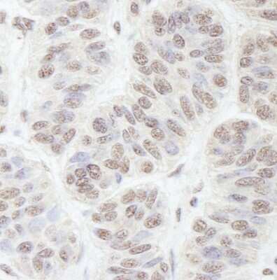 <b>Independent Antibodies Validation and Biological Strategies Validation.</b>Immunohistochemistry: Nucleostemin Antibody [NB100-1568] - Sample: FFPE section of human skin carcinoma. Antibody: Affinity purified rabbit anti-GNL3 used at a dilution of 1:200 (1ug/ml). Detection: DAB