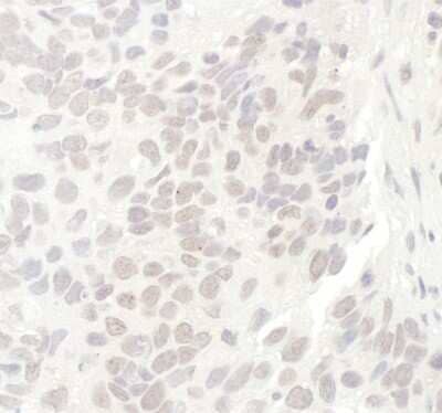 Immunohistochemistry: Nucleostemin Antibody [NB100-1569] - Sample: FFPE section of human lung cancer. Antibody: Affinity purified rabbit anti-GNL3 used at a dilution of 1:200 (1ug/ml). Detection: DAB