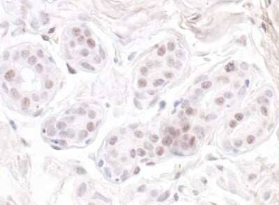 Immunohistochemistry: Nucleostemin Antibody [NB100-1569] - Detection of human GNL3 by immunohistochemistry. Sample: FFPE section of human breast carcinoma. Antibody: Affinity purified rabbit anti-GNL3 (NB100-1569). Detection: DAB