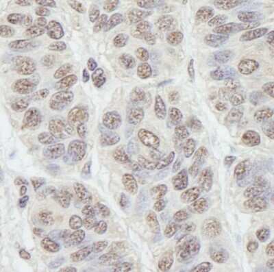 Immunohistochemistry-Paraffin: Nucleostemin Antibody [NB100-1569] - Human skin carcinoma.  Antibody used at a dilution of 1:1,000.