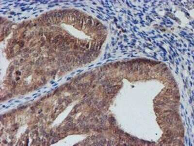 Immunohistochemistry: Nucleotide binding protein like Antibody (OTI5D5) - Azide and BSA Free [NBP2-73094] - Staining of paraffin-embedded Adenocarcinoma of Human endometrium tissue using anti-Nucleotide binding protein like mouse monoclonal antibody.