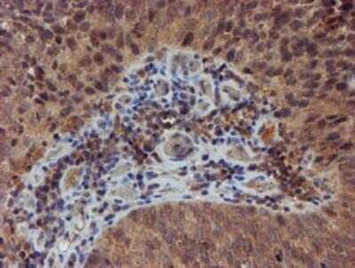 Immunohistochemistry: Nucleotide binding protein like Antibody (OTI5D5) - Azide and BSA Free [NBP2-73094] - Staining of paraffin-embedded Carcinoma of Human bladder tissue using anti-Nucleotide binding protein like mouse monoclonal antibody.