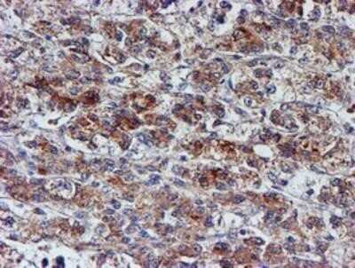 Immunohistochemistry: Nucleotide binding protein like Antibody (OTI5D5) - Azide and BSA Free [NBP2-73094] - Staining of paraffin-embedded Carcinoma of Human liver tissue using anti-Nucleotide binding protein like mouse monoclonal antibody.