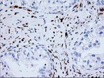 Immunohistochemistry-Paraffin: Nudel Antibody (5E11) [NBP2-01086] - Staining of paraffin-embedded Adenocarcinoma of Human ovary tissue using anti-Nudel mouse monoclonal antibody.