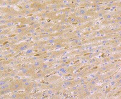 Immunohistochemistry: Nudel Antibody (JG38-63) [NBP2-76854] - Immunohistochemical analysis of paraffin-embedded human liver cancer tissue using anti-Nudel antibody. Counter stained with hematoxylin.