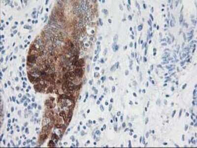 Immunohistochemistry: Nudel Antibody (OTI5E11) - Azide and BSA Free [NBP2-73104] - Staining of paraffin-embedded Adenocarcinoma of Human endometrium tissue using anti-Nudel mouse monoclonal antibody.