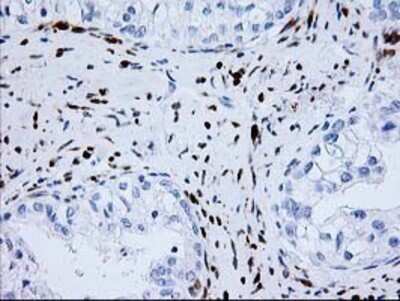 Immunohistochemistry: Nudel Antibody (OTI5E11) - Azide and BSA Free [NBP2-73104] - Staining of paraffin-embedded Adenocarcinoma of Human ovary tissue using anti-Nudel mouse monoclonal antibody.