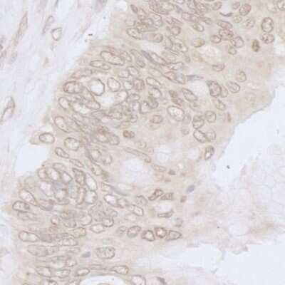 Immunohistochemistry-Paraffin: Nup53 Antibody [NB100-93322] - Sample: FFPE section of human colon carcinoma. Antibody: Affinity purified rabbit anti- NUP35 used at a dilution of 1:1,000 (1ug/ml). Detection: DAB