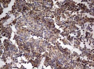 Immunohistochemistry: OAS2 Antibody (6E6) [NBP2-46293] - Analysis of Human lymphoma tissue.