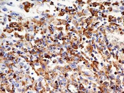 Immunohistochemistry-Paraffin: OATP1B3/SLCO1B3/OATP8 Antibody (1E6.2F9) [NBP2-36492] - Analysis of formalin-fixed paraffin-embedded tissue section of human renal cell carcinoma using mouse monoclonal OATP1B3/SLCO1B3/OATP8 antibody (1E6.2F9) at 5 ug/ml concentration.