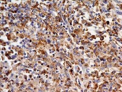 Immunohistochemistry: OATP1B3/SLCO1B3/OATP8 Antibody (1F6.1B1) - Azide and BSA Free [NBP2-80889] - Analysis of formalin-fixed paraffin-embedded tissue section of human renal cell carcinoma using mouse monoclonal OATP1B3/SLCO1B3/OATP8 antibody (1F6.1B1) at 5 ug/ml concentration. Image from the standard format of this antibody.