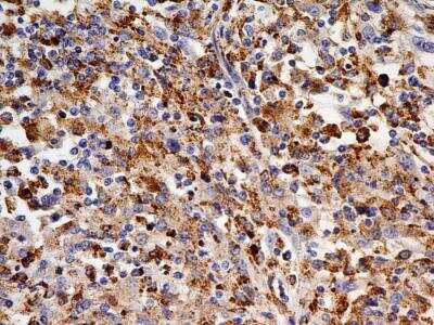 Immunohistochemistry-Paraffin: OATP1B3/SLCO1B3/OATP8 Antibody (1F6.1B1) [NBP2-36493] - Analysis of formalin-fixed paraffin-embedded tissue section of human renal cell carcinoma using mouse monoclonal OATP1B3/SLCO1B3/OATP8 antibody (1F6.1B1) at 5 ug/ml concentration.