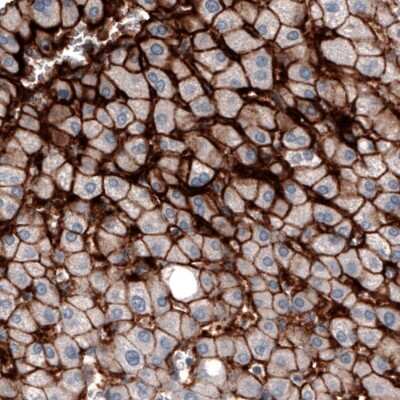 Immunohistochemistry-Paraffin: OATP1B3/SLCO1B3/OATP8 Antibody (CL3771) [NBP2-61637] - Staining of human liver shows strong membranous immunoreactivity in hepatocytes.