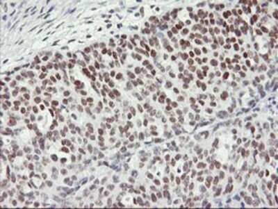 Immunohistochemistry: OBFC2B Antibody (OTI1E11) - Azide and BSA Free [NBP2-73140] - Staining of paraffin-embedded Adenocarcinoma of Human ovary tissue using anti-OBFC2B mouse monoclonal antibody.