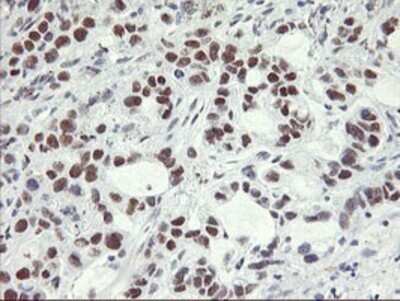 Immunohistochemistry: OBFC2B Antibody (OTI1E11) - Azide and BSA Free [NBP2-73140] - Staining of paraffin-embedded Carcinoma of Human lung tissue using anti-OBFC2B mouse monoclonal antibody.