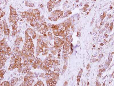 Immunohistochemistry-Paraffin: OCRL Antibody [NBP2-19621] - Human breast cancer, using OCRL antibody at 1:250 dilution.  Antigen Retrieval: Trilogy™ (EDTA based, pH 8.0) buffer, 15min. 