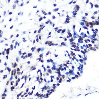 Immunohistochemistry-Paraffin: OCT1 Antibody (8L4Y5) [NBP3-16246] - Immunohistochemistry of paraffin-embedded human esophageal cancer using POU2F1/OCT1 Rabbit mAb (NBP3-16246) at dilution of 1:100 (40x lens).Perform microwave antigen retrieval with 10 mM PBS buffer pH 7.2 before commencing with IHC staining protocol.