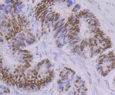 Immunohistochemistry-Paraffin: OCT1 Antibody (JG62-35) [NBP2-75600] - Analysis of paraffin-embedded human colon cancer tissue using anti-Oct-1 antibody. Counter stained with hematoxylin.