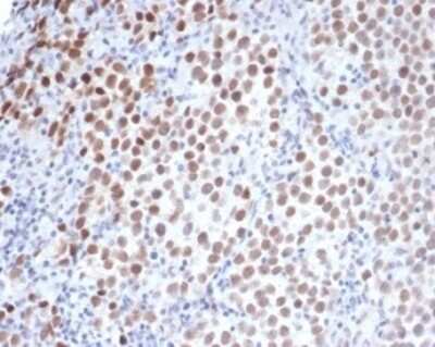 Immunohistochemistry-Paraffin: OCT4 Antibody (OCT4/3508) [NBP3-13744] - Formalin-fixed, paraffin-embedded human seminoma stained with OCT4 antibody (OCT4/3508) at 2ug/ml. HIER: Tris/EDTA, pH9.0, 45min. HRP-polymer, 30min. DAB, 5min.