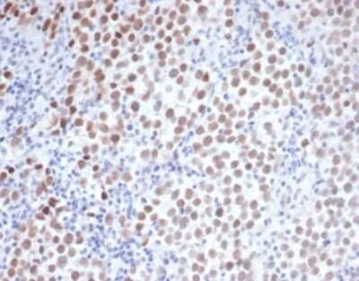 Immunohistochemistry-Paraffin: OCT4 Antibody (OCT4/3508) [NBP3-13744] - Formalin-fixed, paraffin-embedded human seminoma stained with OCT4 antibody (OCT4/3508) at 2ug/ml. HIER: Tris/EDTA, pH9.0, 45min. HRP-polymer, 30min. DAB, 5min.