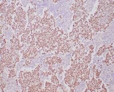 Immunohistochemistry-Paraffin: OCT4 Antibody (OCT4/6875R) [NBP3-13745] - Formalin-fixed, paraffin-embedded human seminoma stained with OCT4 antibody (OCT4/6875R) at 2ug/ml. HIER: Tris/EDTA, pH9.0, 45min. HRP-polymer, 30min. DAB, 5min.