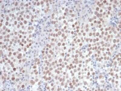 Immunohistochemistry-Paraffin: OCT4 Antibody (OCT4/6875R) [NBP3-13745] - Formalin-fixed, paraffin-embedded human seminoma stained with OCT4 antibody (OCT4/6875R) at 2ug/ml. HIER: Tris/EDTA, pH9.0, 45min. HRP-polymer, 30min. DAB, 5min.