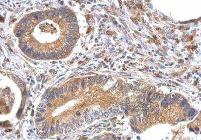 Immunohistochemistry-Paraffin: OFD1 Antibody [NBP1-32843] -  Paraffin-embedded gastric cancer. OFD1 antibody dilution: 1:500.