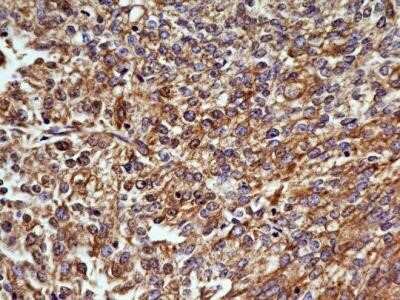 Immunohistochemistry: OGG1 Antibody (4E8) - Azide and BSA Free [NBP2-80890] - Analysis of OGG1 antibody (clone 4E8) at 5 ug/ml generated a general cytoplasmic staining pattern with intense nuclear staining in select cells endometrial carcinoma. Image from the standard format of this antibody.