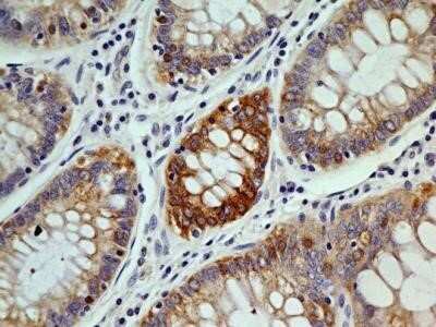 Immunohistochemistry: OGG1 Antibody (4E8) - Azide and BSA Free [NBP2-80890] - Analysis of OGG1 antibody (clone 4E8) at 5 ug/ml generated a general cytoplasmic staining pattern with intense nuclear staining in select cells rectum adenocarcinoma. Image from the standard format of this antibody.