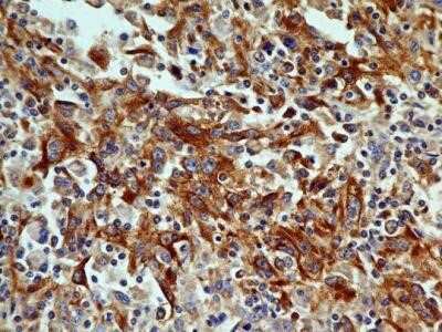 Immunohistochemistry: OGG1 Antibody (4E8) - Azide and BSA Free [NBP2-80890] - Analysis of OGG1 antibody (clone 4E8) at 5 ug/ml generated a general cytoplasmic staining pattern with intense nuclear staining in select cells renal cell carcinoma. Image from the standard format of this antibody.