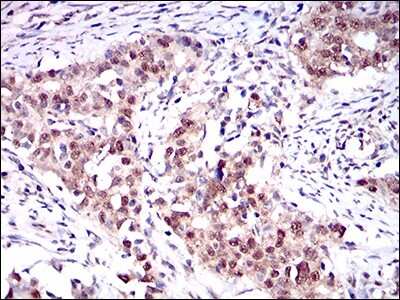 Immunohistochemistry-Paraffin: ONECUT3 Antibody (10B2F5) [NBP2-37340] - Analysis of cervical cancer tissues using ONECUT3 mouse mAb with DAB staining.