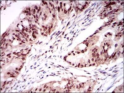 Immunohistochemistry-Paraffin: ONECUT3 Antibody (10B2F5) [NBP2-37340] - Analysis of rectum cancer tissues using ONECUT3 mouse mAb with DAB staining.