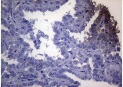 Immunohistochemistry: OPA3 Antibody (OTI3G4) - Azide and BSA Free [NBP2-73147] - Staining of paraffin-embedded Carcinoma of Human thyroid tissue using anti-OPA3 mouse monoclonal antibody.(Heat-induced epitope retrieval by 1mM EDTA in 10mM Tris buffer (pH8.5) at 120 degrees C for 3 min)(1:150)