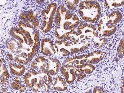 Immunohistochemistry-Paraffin: OPHN1 Antibody [NBP2-99305] - Immunochemical staining of human OPHN1 in human gastric cancer with rabbit polyclonal antibody at 1:300 dilution, formalin-fixed paraffin embedded sections.